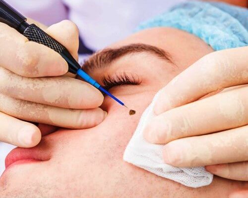 Mole removal Mole removal