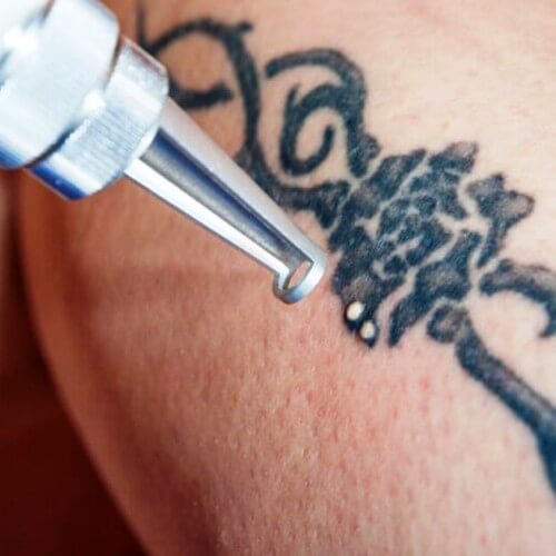 Tattoo Removal